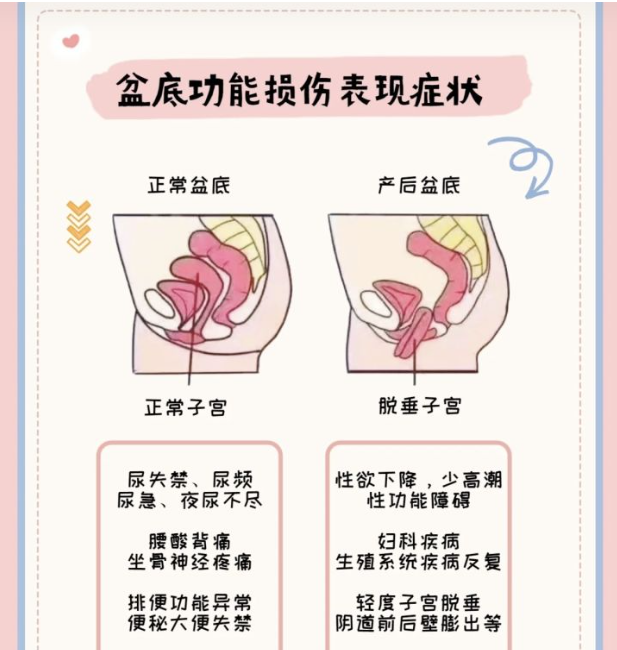 為什么要做產后盆底康復